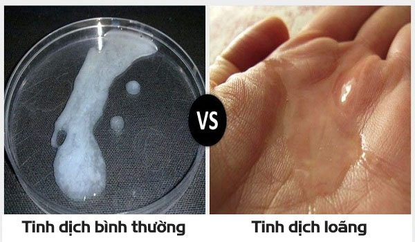 Hình ảnh tinh dịch bình thường và bất bình thường nam giới nên lưu ý