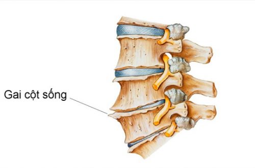 Bệnh gai cột sống chữa được không? Điều trị thế nào?