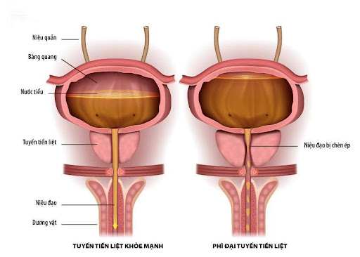 Tadalafil 5mg trong điều trị tăng sản lành tính tuyến tiền liệt ở nam giới
